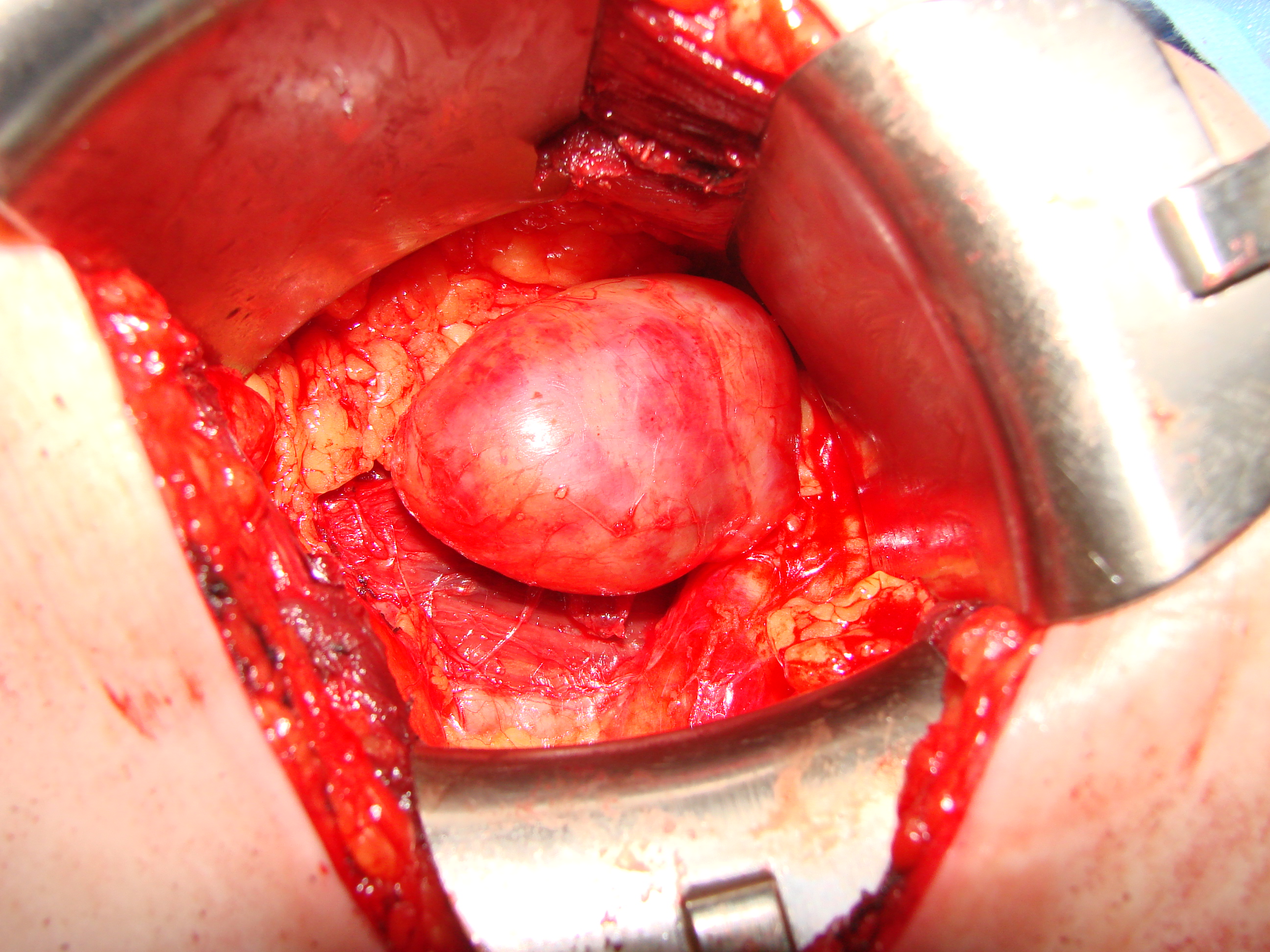Retroperitoneal Tumor Hot Sex Picture