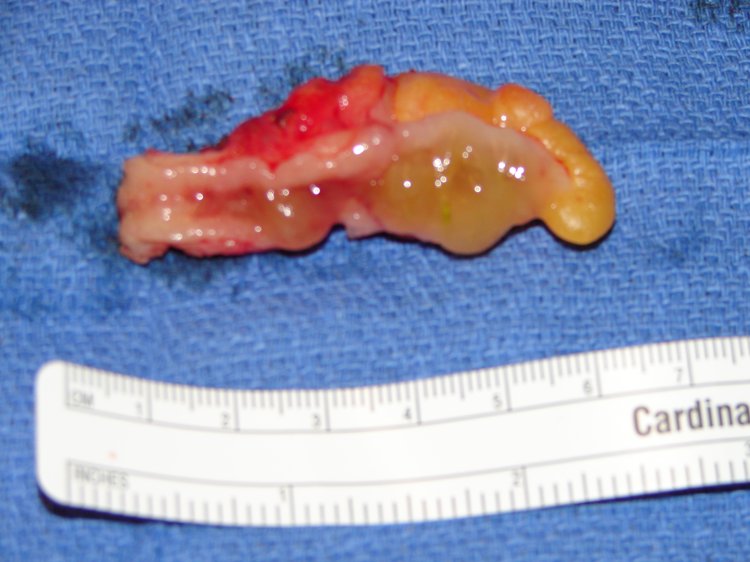 appendix-neoplasm-1381-appendix-incidental-mucocele-open-surgery-photos