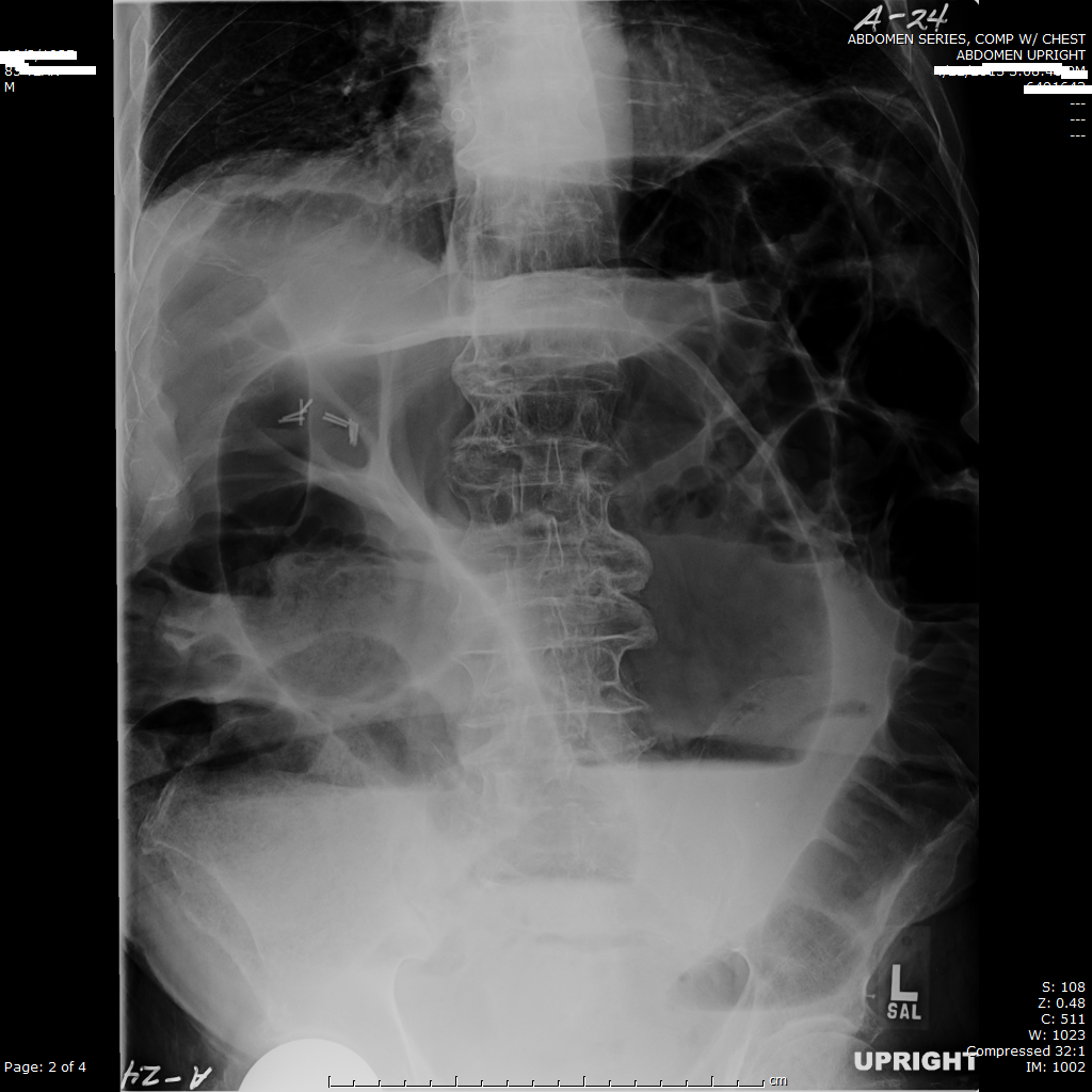 Sigmoid Surgery Photos