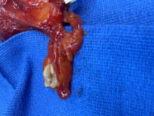 Appendix carcinoid tumor 1.5 cm