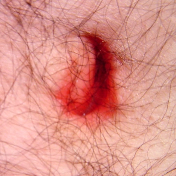 Umbilicus 1101 Omphalitis